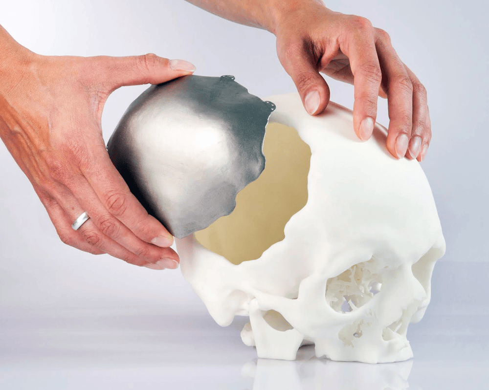 Patient-specific implants